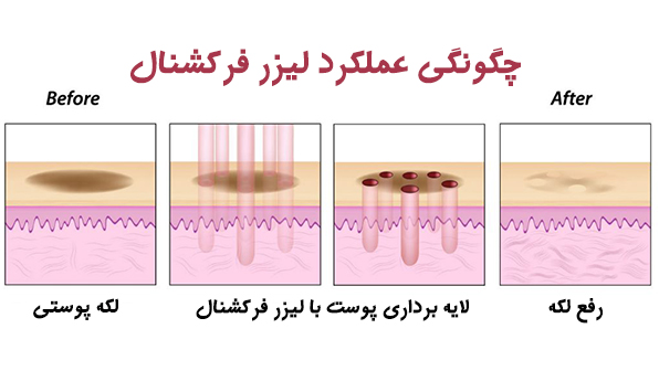 عملکرد لیزر فرکشنال