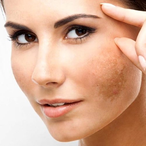 روش های درمان لک های پوستی
